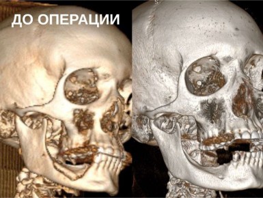 Ставропольские хирурги помогли онко-пациенту справиться с остеонекрозом челюсти