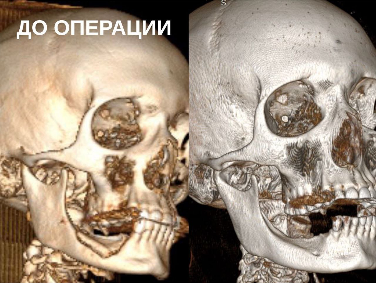 Ставропольские хирурги помогли онко-пациенту справиться с остеонекрозом челюсти