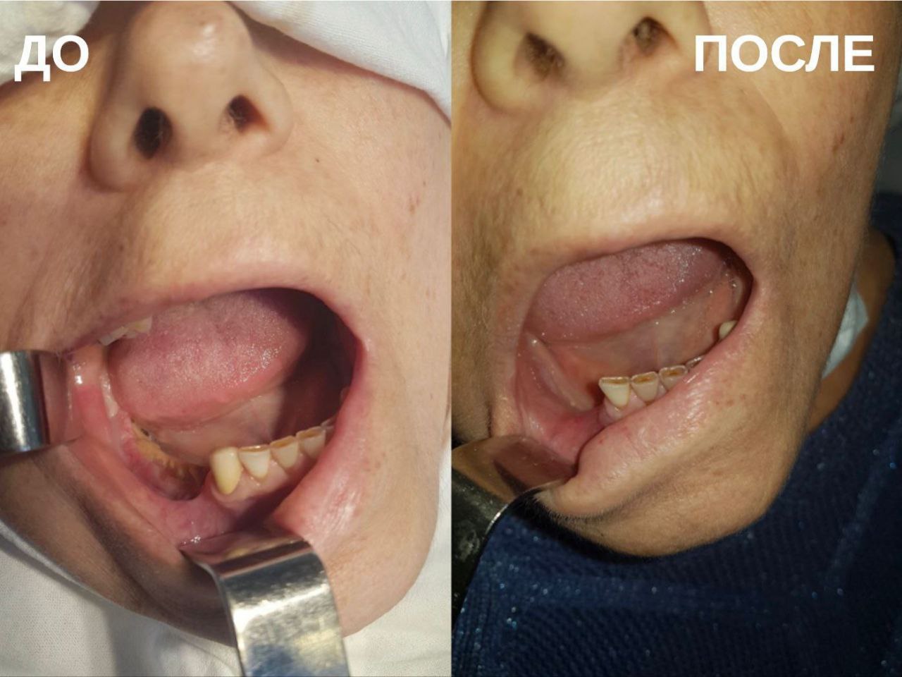 Ставропольские хирурги помогли онко-пациенту справиться с остеонекрозом челюсти Ставропольские хирурги помогли онко-пациенту справиться с остеонекрозом челюсти