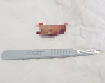 В Ставрополе хирурги помогли мужчине с онкологией справиться с осложнением остеонекроза челюсти