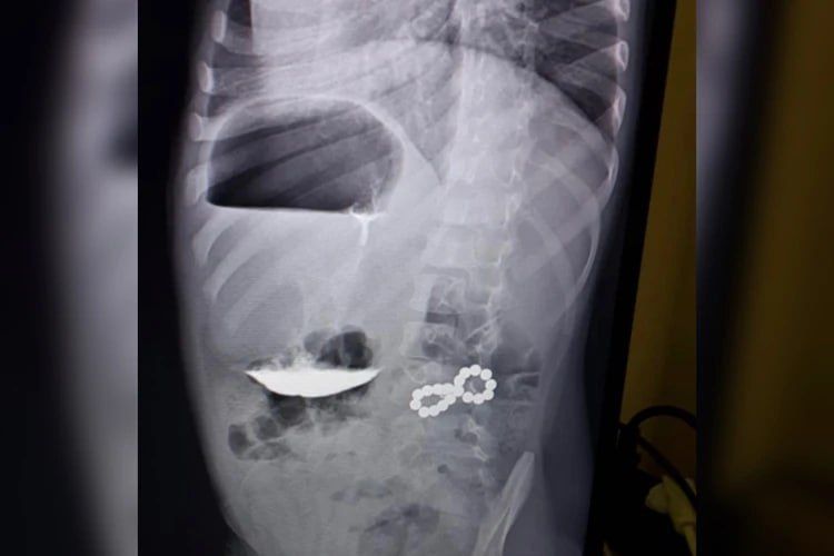 В Ставрополе трехлетний мальчик проглотил 18 магнитов