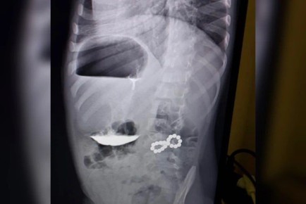 В Ставрополе трехлетний мальчик проглотил 18 магнитов