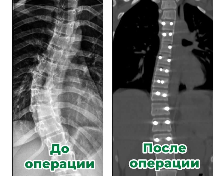 Сложнейшую операцию на позвоночнике провели ставропольские врачи