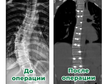 Сложнейшую операцию на позвоночнике провели ставропольские врачи