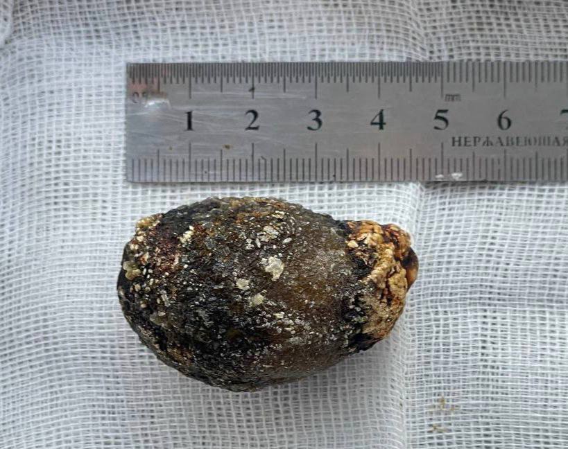 В Пятигорске врачи спасли пациентку с 4-сантиметровым желчным камнем В Пятигорске врачи спасли пациентку с 4-сантиметровым желчным камнем