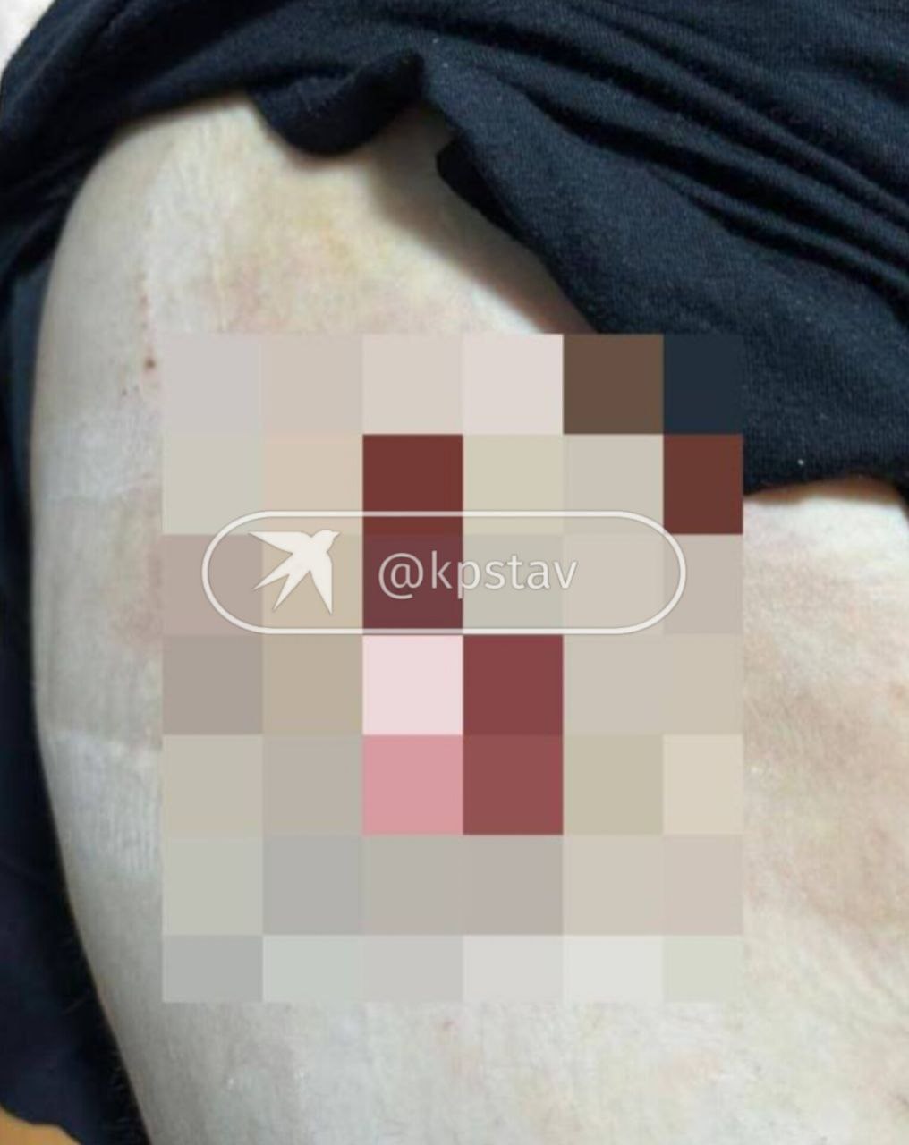 Тащили язык клещами и выгнали с кровотечением: жертва недобросовестного косметолога в Махачкале раскрыла «КП» детали операции