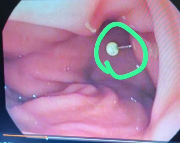 12-летняя девочка проглотила иголку в Ингушетии