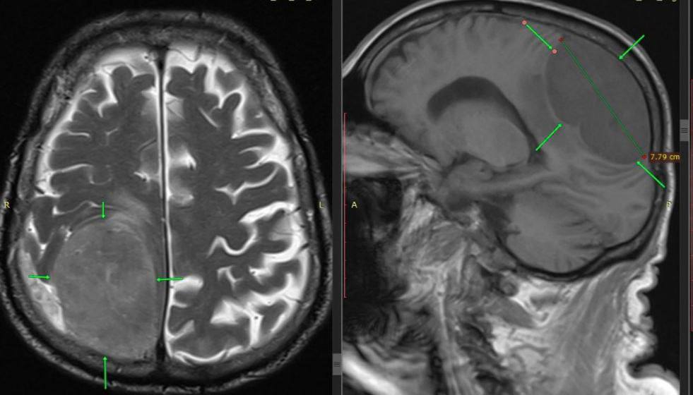 Опухоль размером с лимон удалили из головы пенсионера пятигорские хирурги
