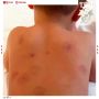 Шестнадцать укусов обнаружили родители на теле двухлетнего мальчика после детсада