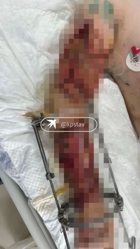 Бросился под КамАЗ за котенком: школьник со Ставрополья получил 19 переломов и выжил